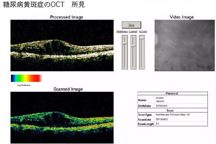 糖尿病黄班症のOCT 所見